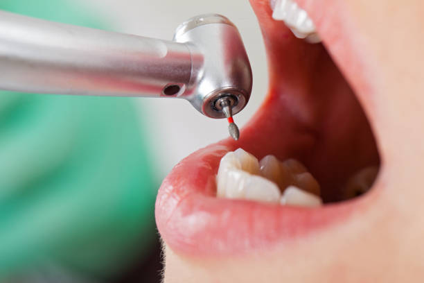 Best Emergency Dentist for Lost Fillings or Crowns in Mountainside, NJ